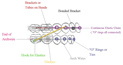 braces diagram